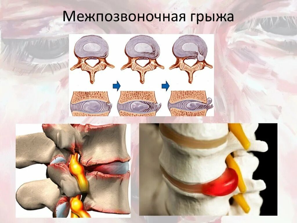 Позвоночная грыжа поясничного отдела симптомы фото Остеопат: лечение грыжи позвоночника, в каких случаях стоит обращаться за помощь