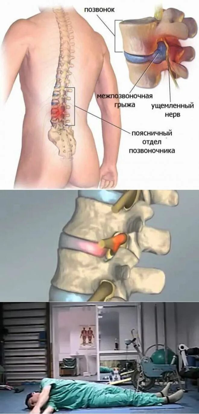 Позвоночная грыжа поясничного отдела симптомы фото Pin de Patricia Silvia Rodriguez en Ejercicios Salud y fitness, Ejercicios, Fitn