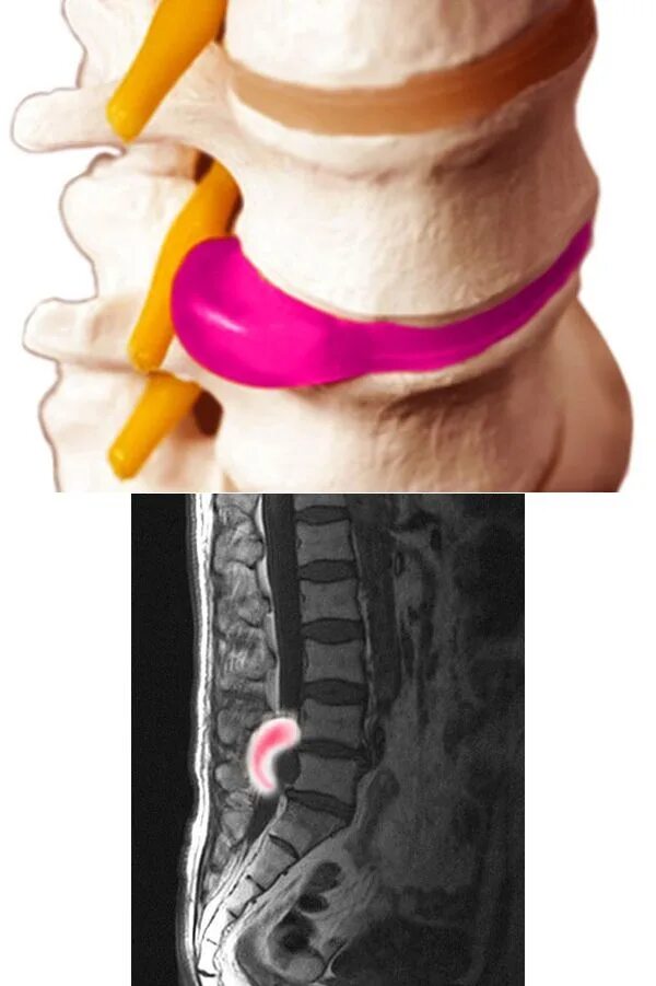 Позвоночная грыжа поясничного отдела симптомы фото Позвоночный столб - это неотъемлемый механизм в нашем теле, который регулярно на