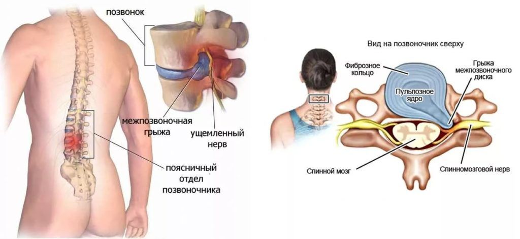 Позвоночная грыжа поясничного отдела симптомы фото Грыжа поясничного отдела позвоночника симптомы, лечение без операции в Москве