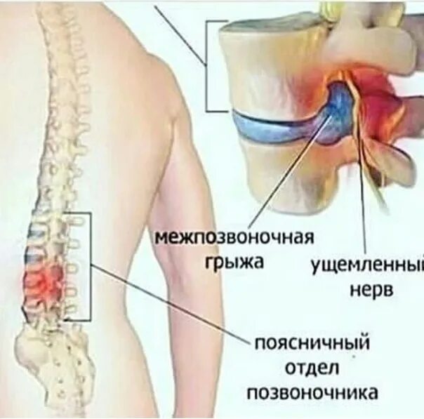 Позвоночная грыжа поясничного отдела симптомы фото Болит нога после операции грыжи позвоночника - найдено 88 фото