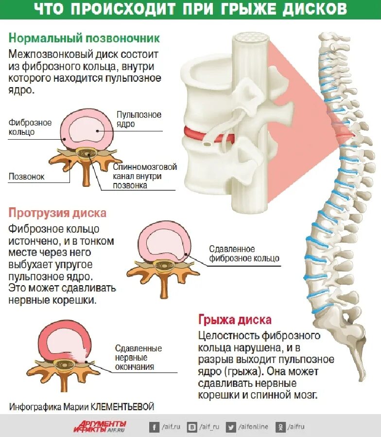 Позвоночная грыжа симптомы фото Лечение межпозвоночной грыжи - Медцентр "Диагност" - Благовещенск