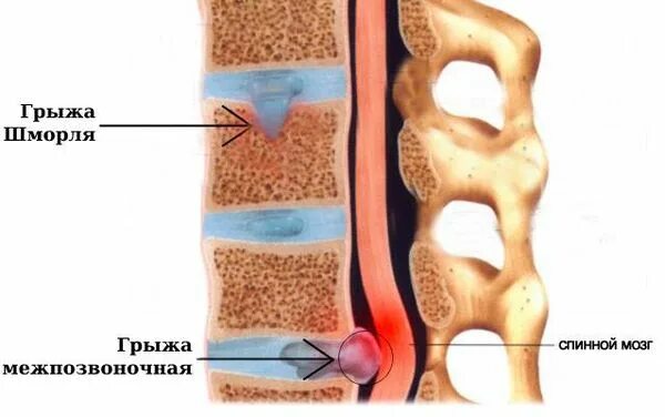 Позвоночная грыжа симптомы фото Грыжа Шморля: причины, симптомы и лечение в статье невролога Котляр Я. А.