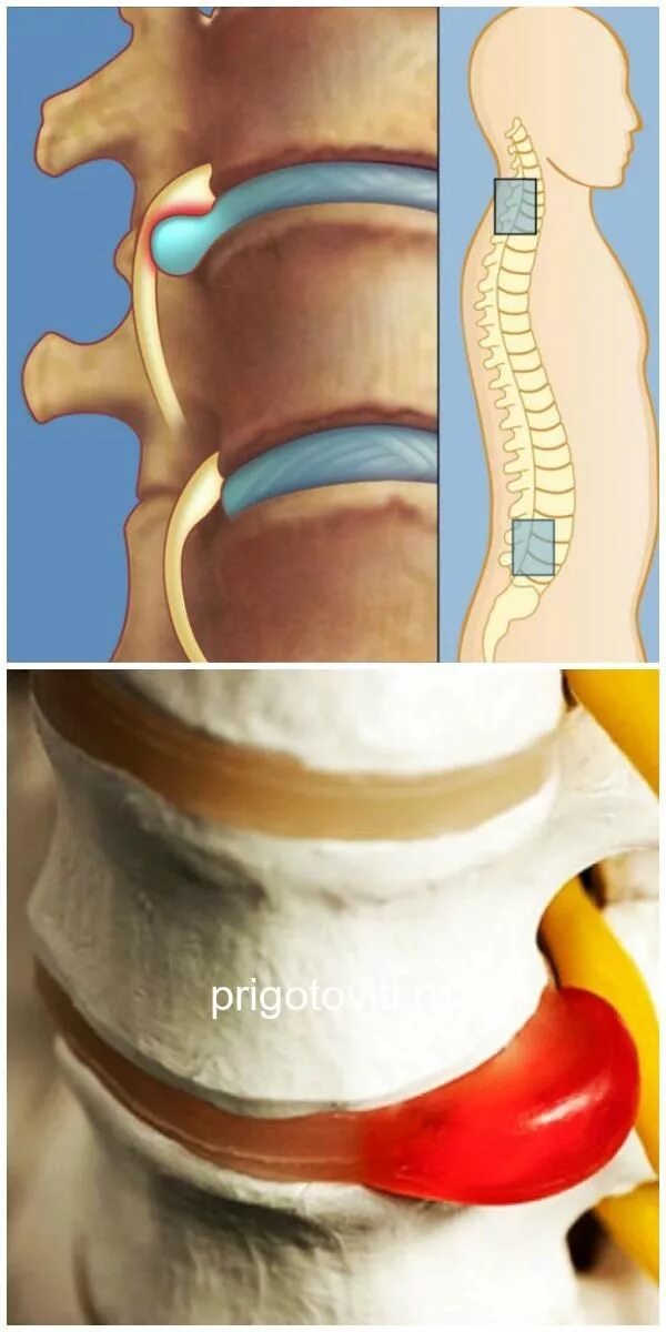 Позвоночная грыжа симптомы фото Картинки МЕЖПОЗВОНКОВАЯ ГРЫЖА ПОЯСНИЧНОГО ОТДЕЛА СИМПТОМЫ
