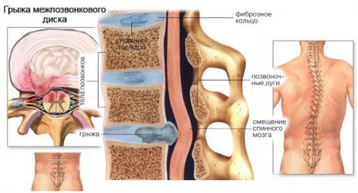 Позвоночная грыжа симптомы фото Психосоматика развития грыжи позвоночника и методы устранения патологии