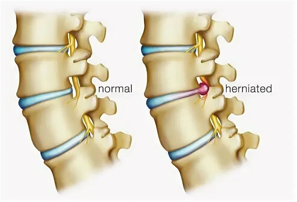 Позвоночная грыжа симптомы фото Herniated and Bulging Disks Causes, Symptoms and Treatment