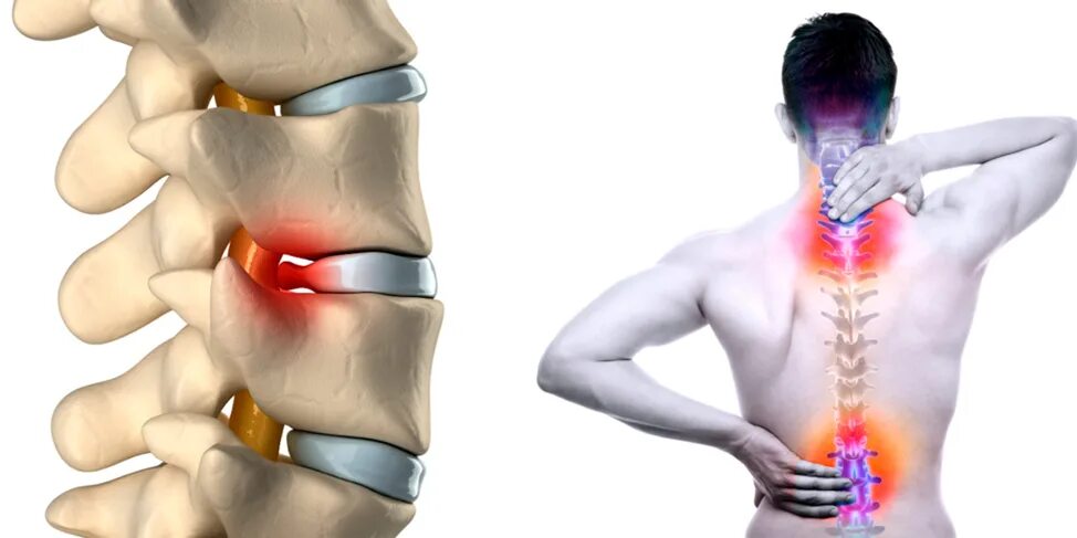 Позвоночная грыжа симптомы фото Межпозвоночная грыжа - Новости учреждения - УЗ "9-я городская поликлиника"