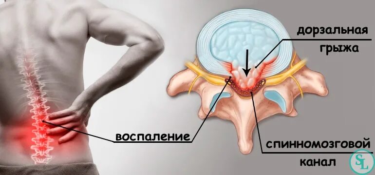 Позвоночная грыжа симптомы фото Малоинвазивная хирургия - операция по удалению грыжи позвоночника клиника в Моск