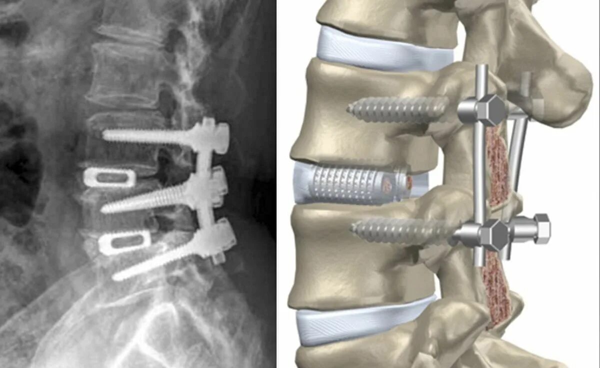 Позвоночные грыжи поясничного отдела фото Нестабильность позвонков операция