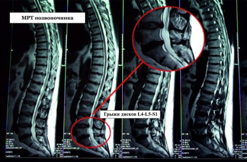 Позвоночные грыжи поясничного отдела фото Грыжа позвоночника. Причины Клиника регенеративной терапии "Здоровье и Долголети