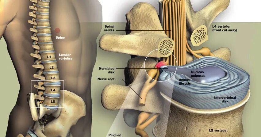 Позвоночные грыжи поясничного отдела фото Проходит ли грыжа позвоночника