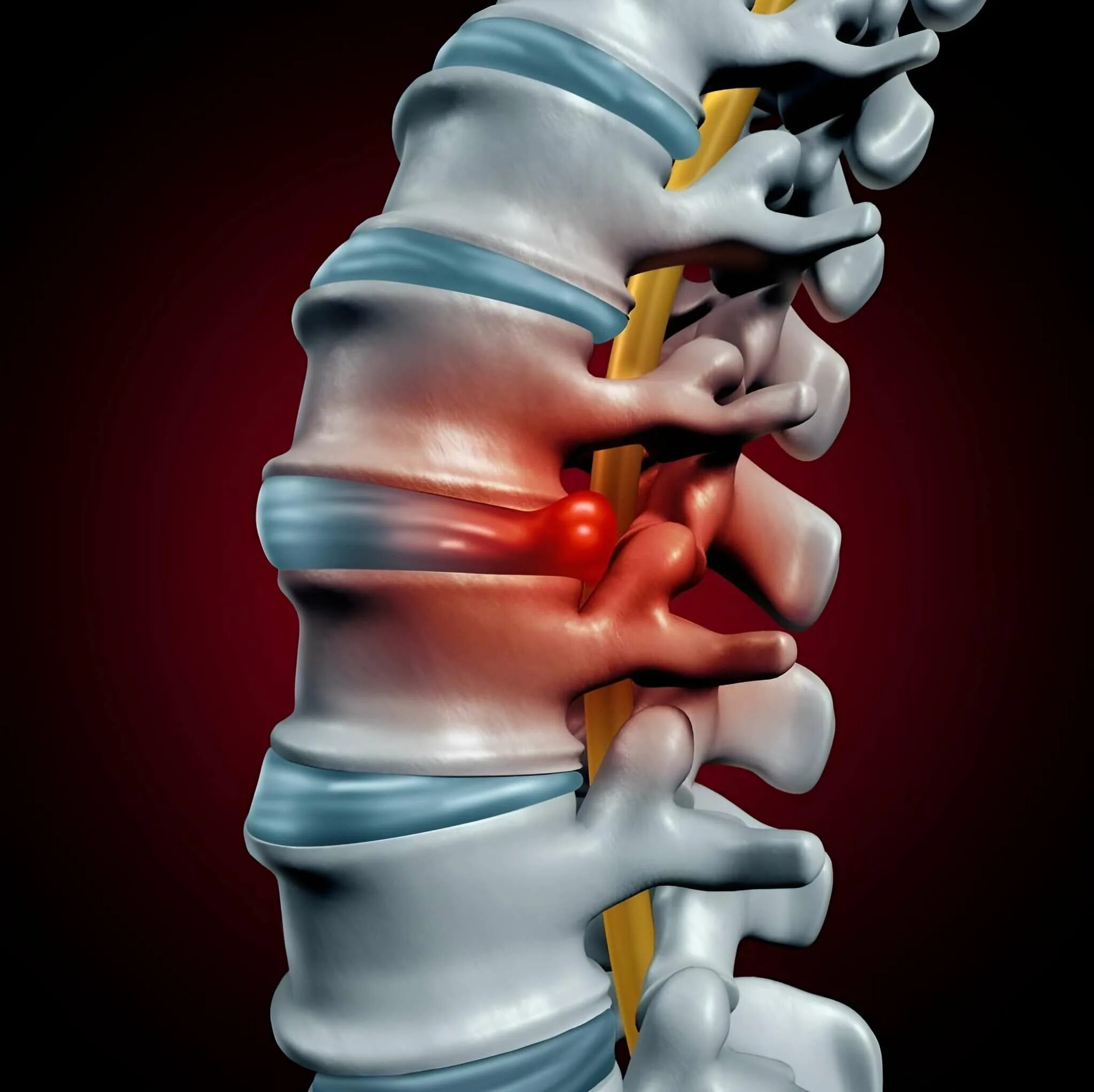 Позвоночные грыжи поясничного отдела фото Лечение позвоночной грыжи без операции в Москве, Одинцово