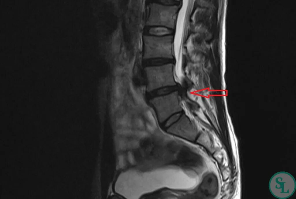 Позвоночные грыжи поясничного отдела фото Грыжа межпозвонкового диска L4-L5 слева