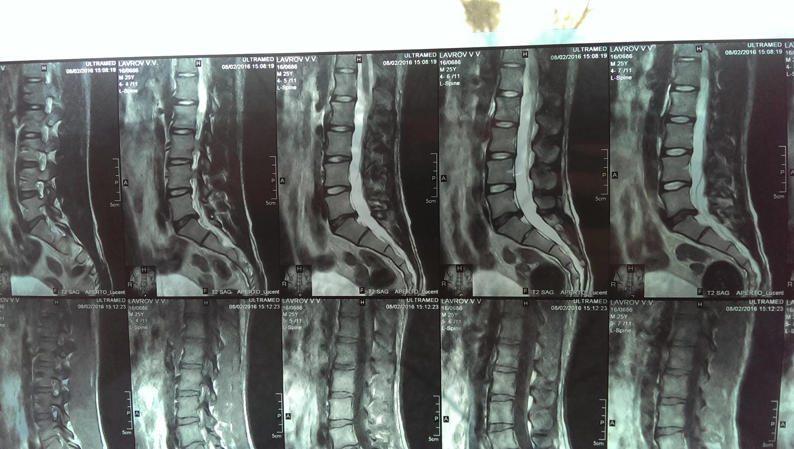 Позвоночные грыжи поясничного отдела фото Мрт пояснично-крестцового отдела Рентгенограммы Сайт Тимура Гусейнова