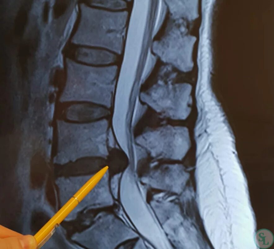 Позвоночные грыжи поясничного отдела фото Как болит межпозвонковая грыжа диска позвоночника