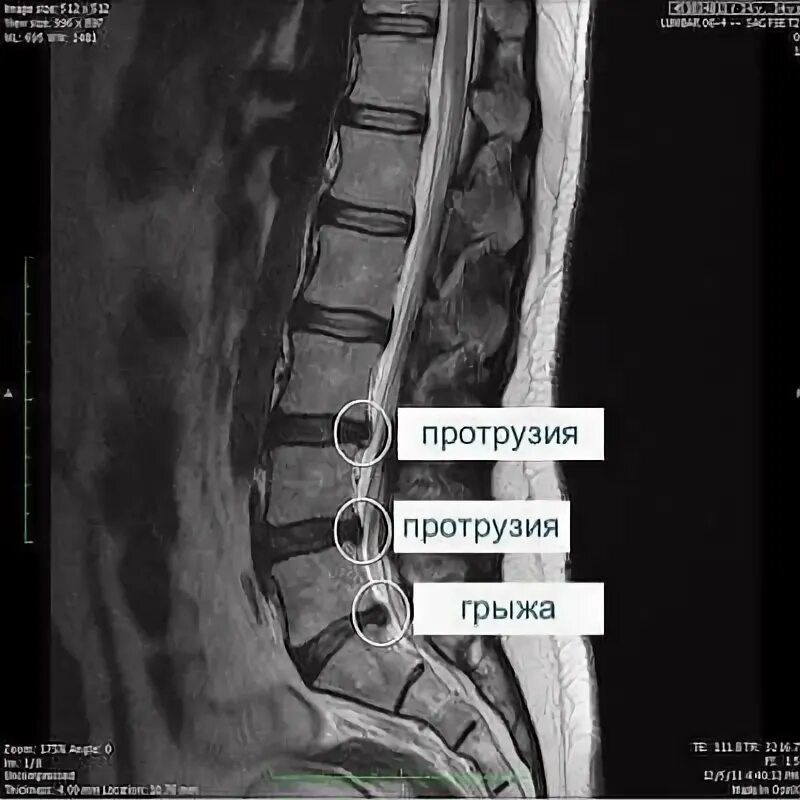 Позвоночные грыжи поясничного отдела фото МРТ при межпозвоночной грыже - процедура, расшифровка, признаки на МРТ снимках