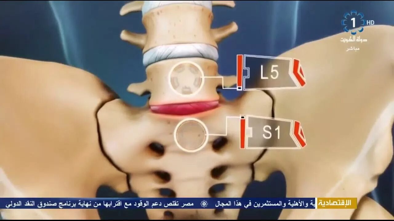 Позвоночные грыжи поясничного отдела фото أهم مشاكل العمود الفقري والديسك وطرق العلاج ج1 - YouTube