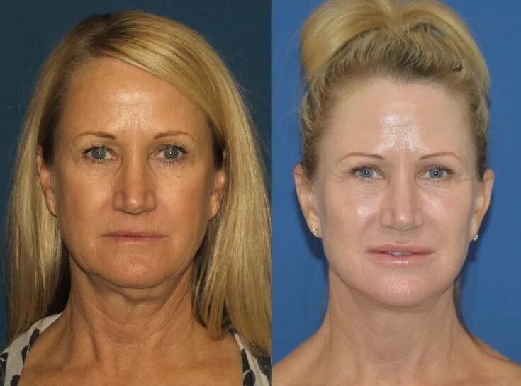 Пр лифтинг лица фото до и после facelift before and after - Google Search Plastic surgery, Facelift before and a