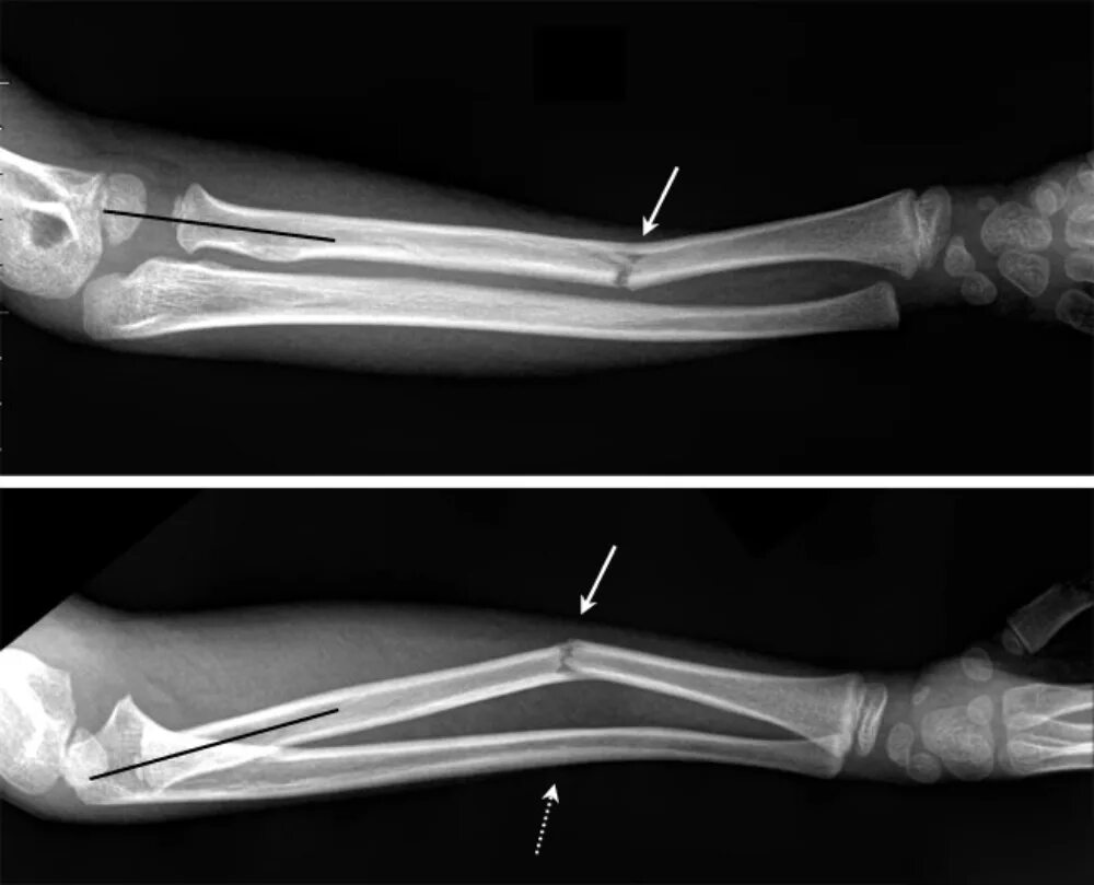 Правая лучевая кость правой руки перелом фото Ребенок сломал ногу: как определить перелом, лечение и восстановление