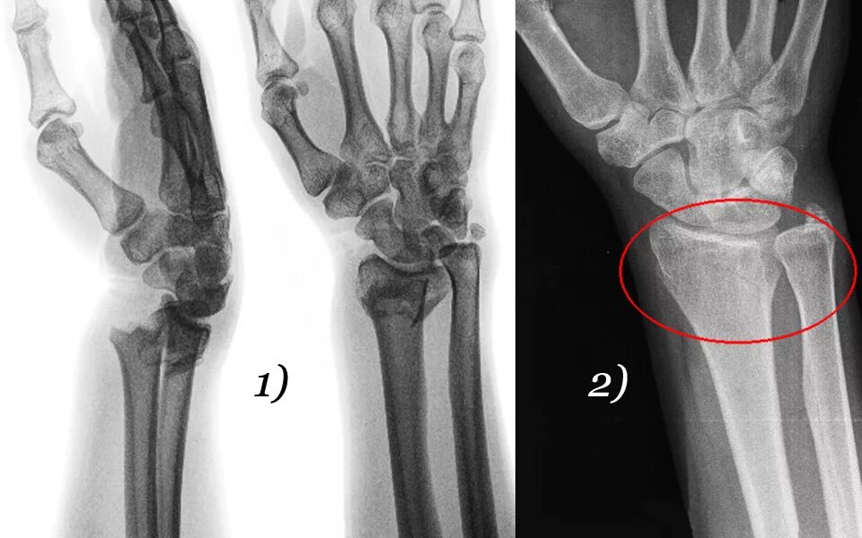 Правая лучевая кость правой руки перелом фото Картинки ЛУЧЕВЫЕ КОСТИ НА РУКЕ