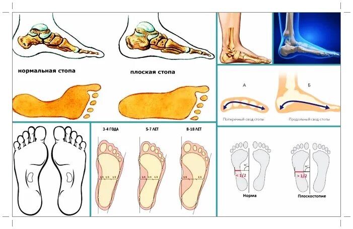 Правильная стопа человека как выглядит фото Бережём свои стопы