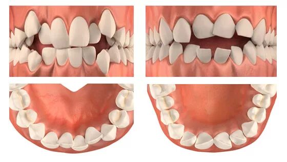 Правильное расположение зубов фото Зачем удалять зубы при ортодонтическом лечении?