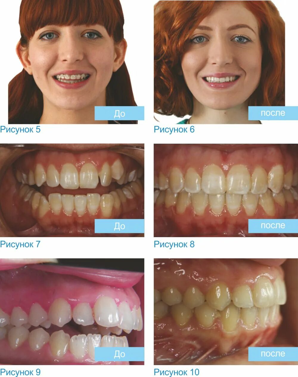 Правильное расположение зубов фото Orthognathic Orthodontics in Limassol - Kokkinos Smile Center