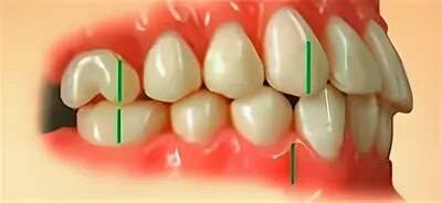 Правильное смыкание зубов фото Правильный прикус и неправильный прикус