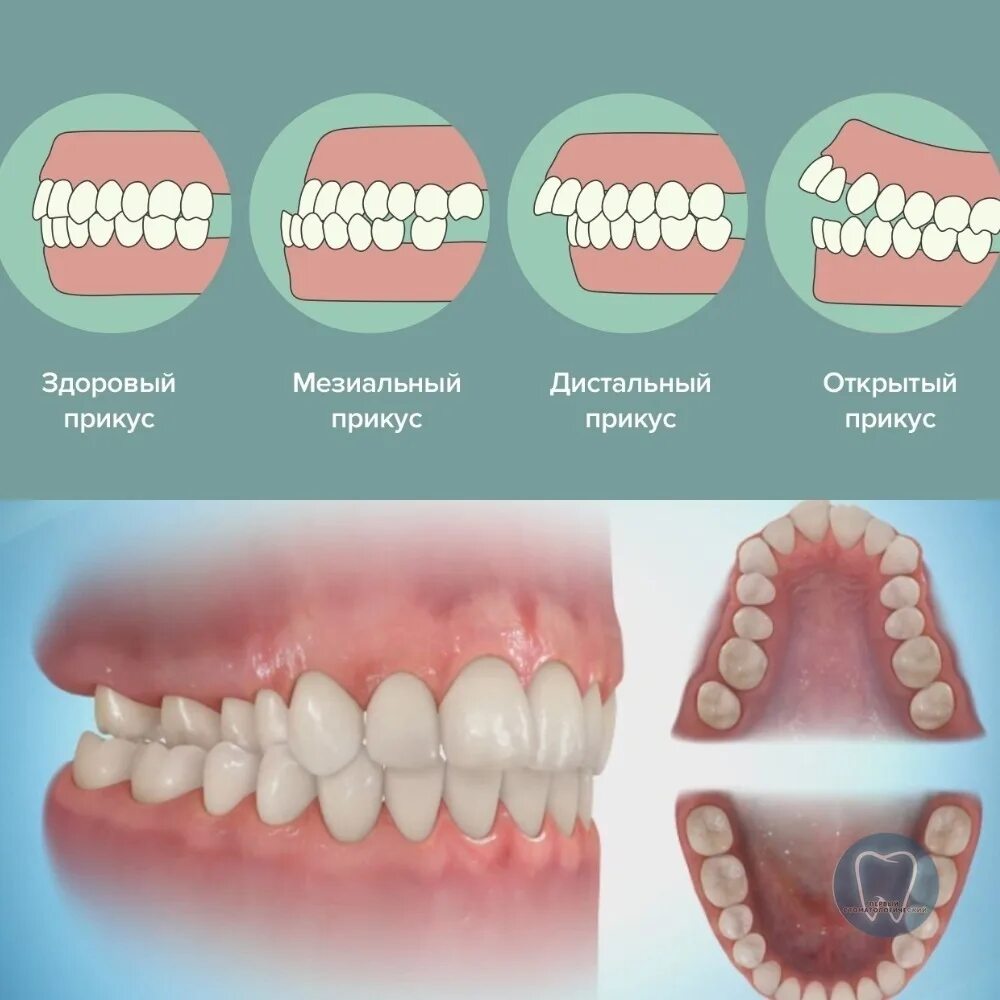 Правильное смыкание зубов фото Неправильный прикус у ребенка: как определить