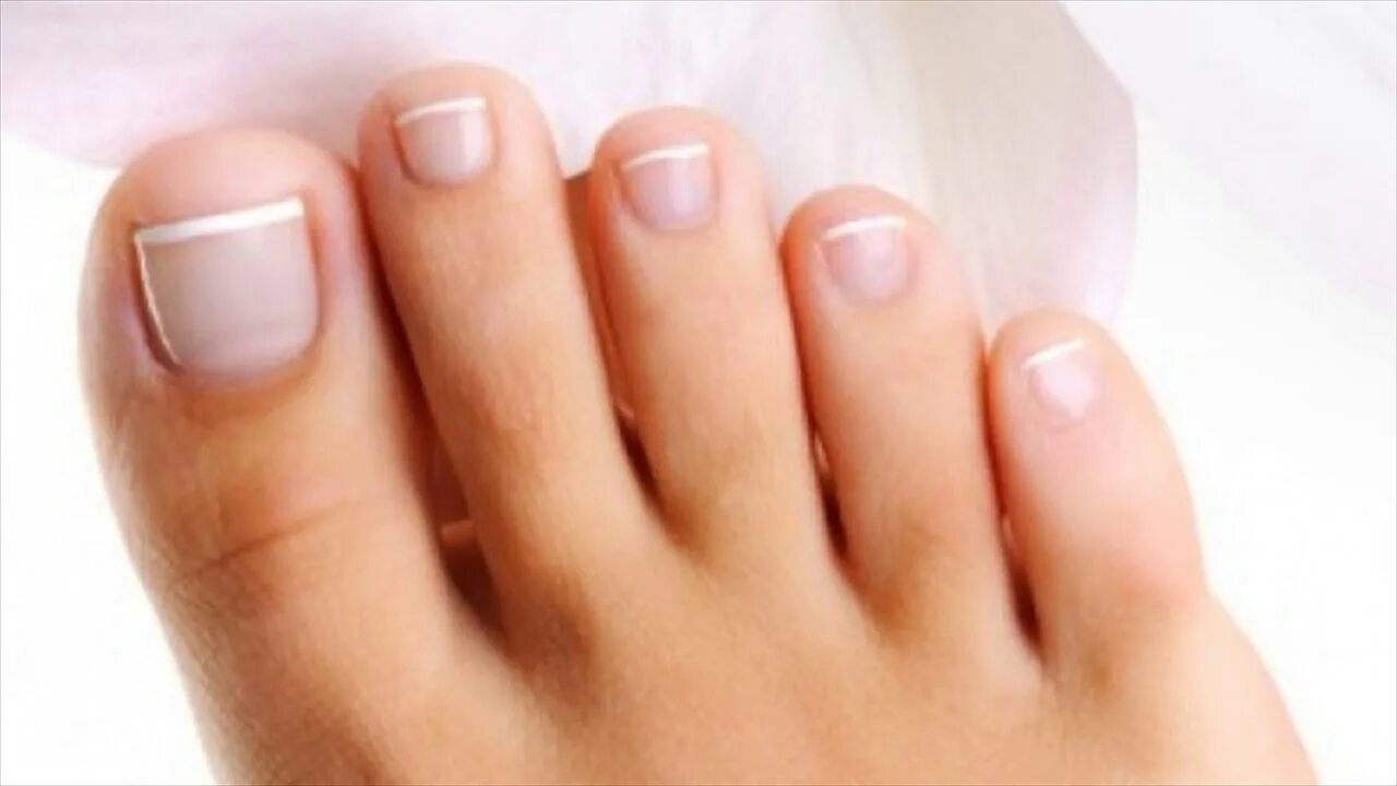 Правильные ногти на ногах фото Effective Remedy For Toe Nail Fungus Is Vinegar- How To Use - YouTube