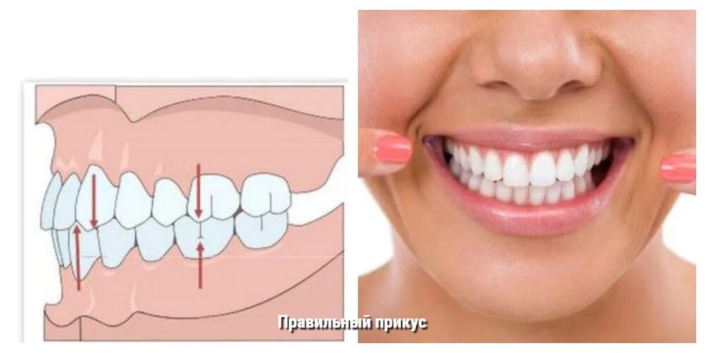 Правильные зубы у женщин как выглядят Неправильный прикус у взрослого и ребенка: какой бывает и почему это проблема