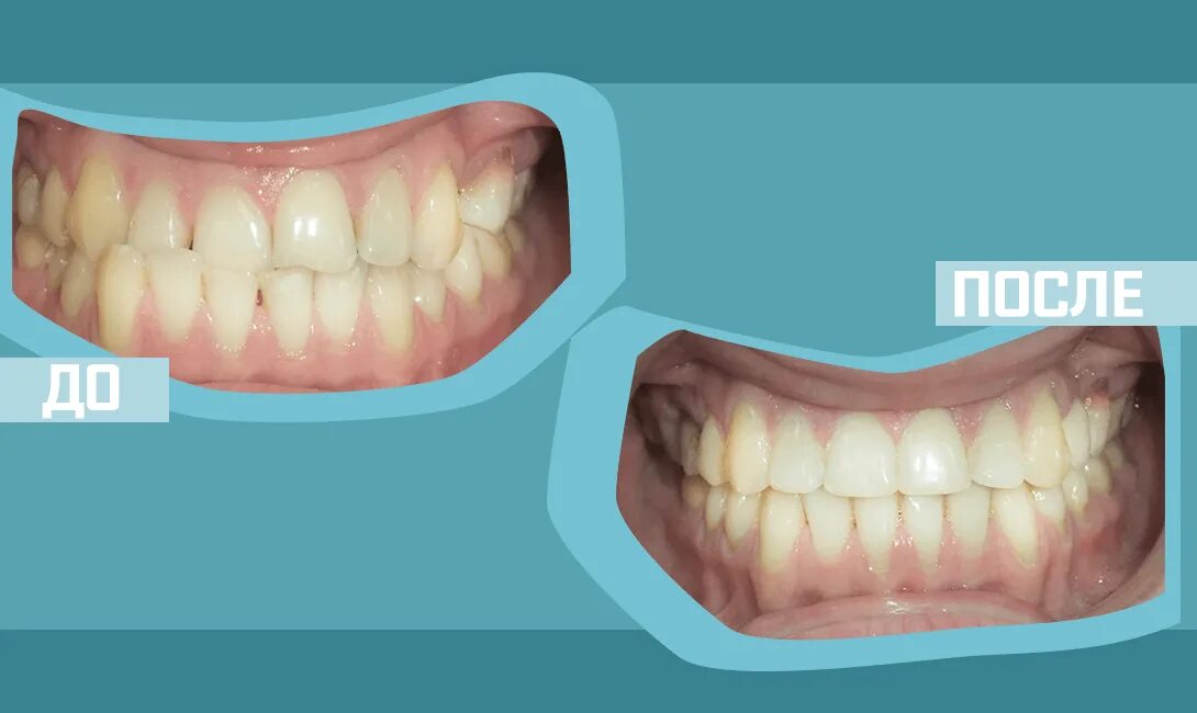 Правильный прикус у человека схема фото Правильный и неправильный прикус у человека: найдено 83 картинок