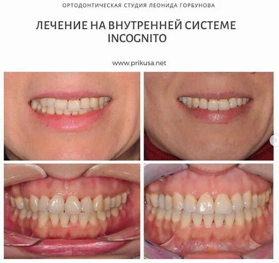 Правильный прикус у человека схема фото Нормальный прикус - правильное расположение зубов при идеальном прикусе