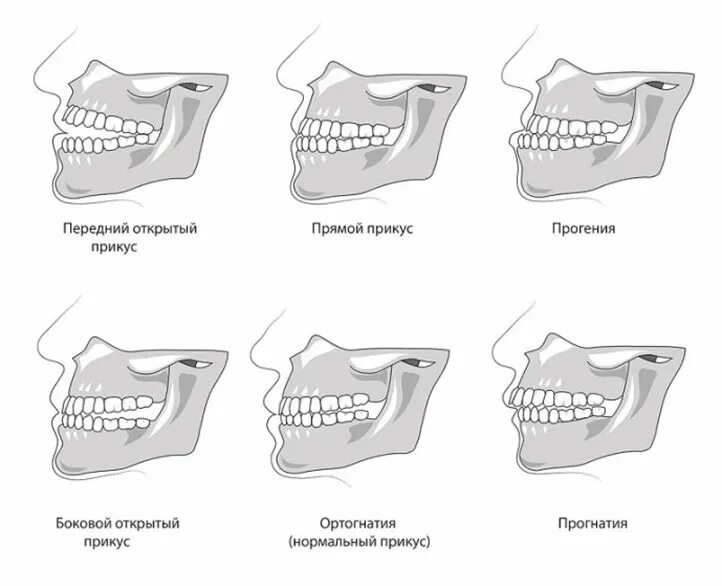 Правильный прикус у человека схема фото Исправление прикуса на Бабушкинской, Медведково в Москве