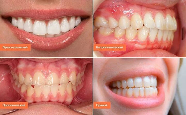 Правильный прикус у человека схема фото Лечение прогенического прикуса