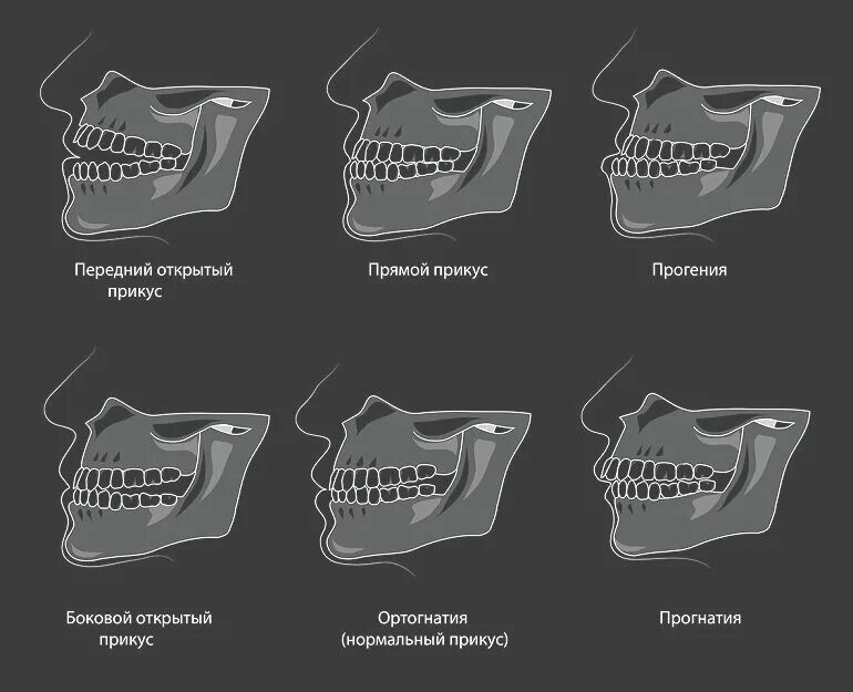Правильный прикус у человека схема фото Проверить прикус. Тест. Ортодонт. Брекеты. Москва. Дзен