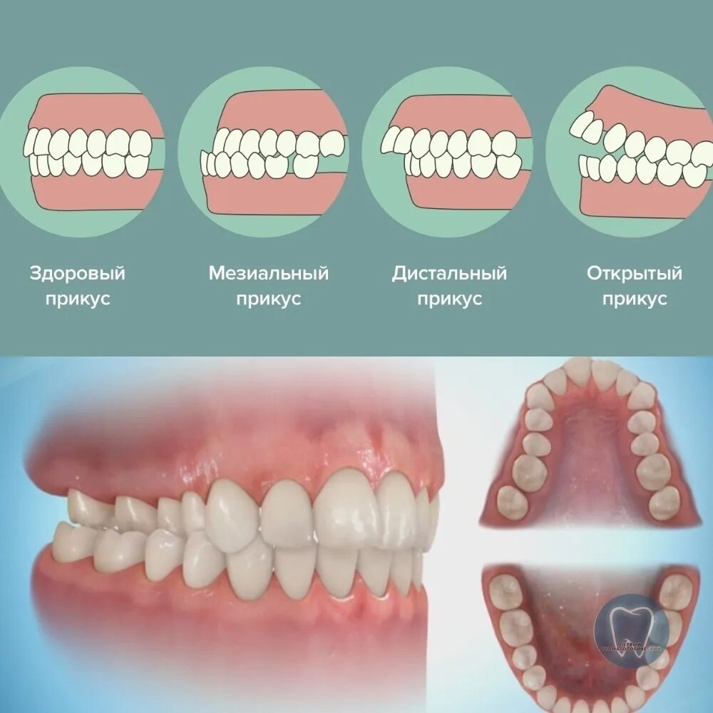 Правильный прикус у человека схема фото Неправильный прикус у ребенка: как определить