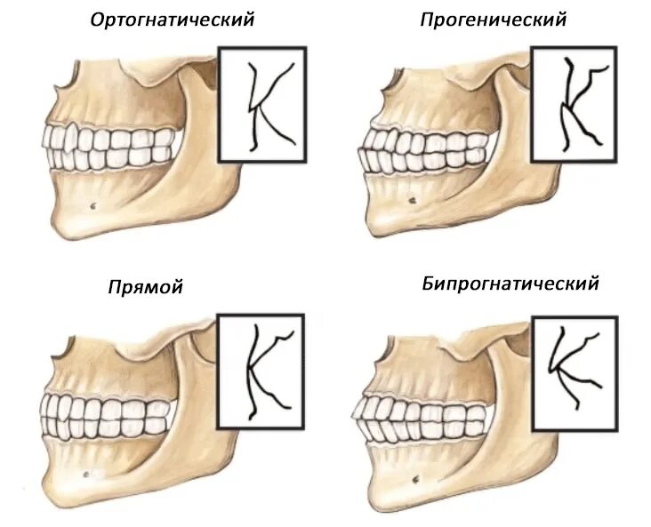 Правильный прикус у человека схема фото Исправление прикуса ортодонтическими методами, стоимость лечения Дентал Мир