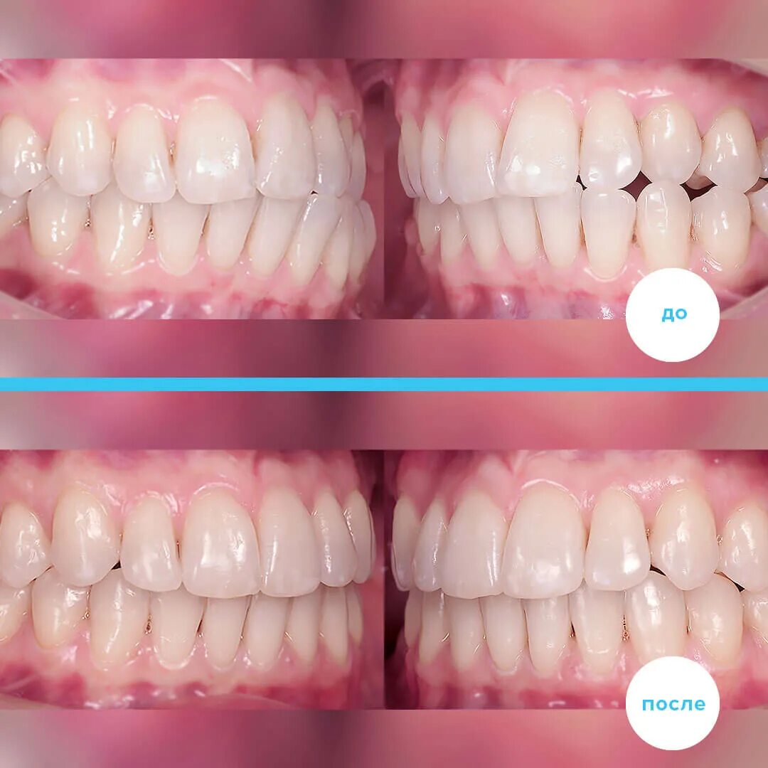 Правильный прикус у человека схема фото Лечение открытого прикуса: до и после, цена, сроки, детальное фото и описание