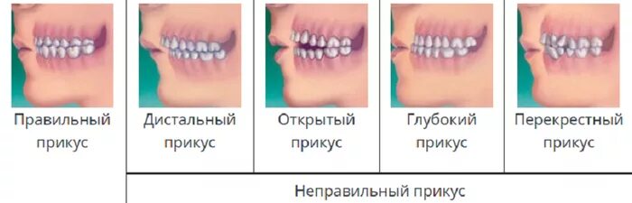 Правильный прикус зубов фото Как исправить неправильный прикус? - Триомед