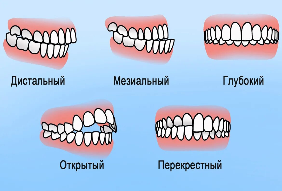 Правильный прикус зубов фото Аномалии роста зубов - Вита 3D