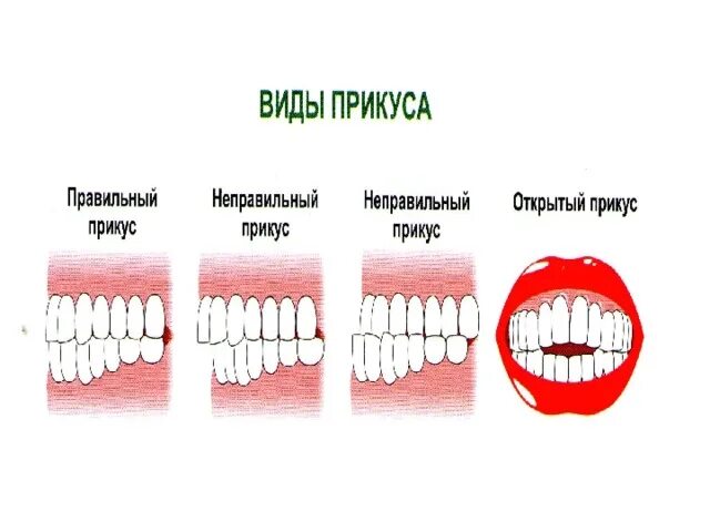 Правильный прикус зубов фото Неправильный прикус у ребенка: как определить