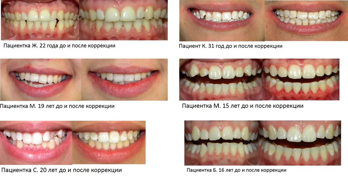 Правильный прикус зубов фото Исправление прикуса взрослым и детям по израильской методике