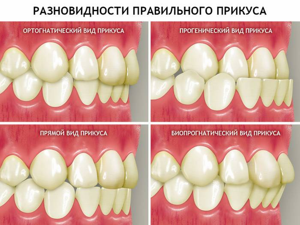 Правильный прикус зубов фото Исправление прикуса