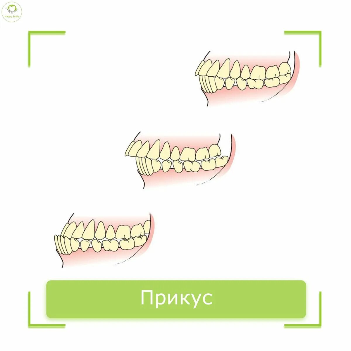 Правильный прикус зубов у человека фото Нарушения прикуса - Стоматологическая клиника "Доктора Матисовой"