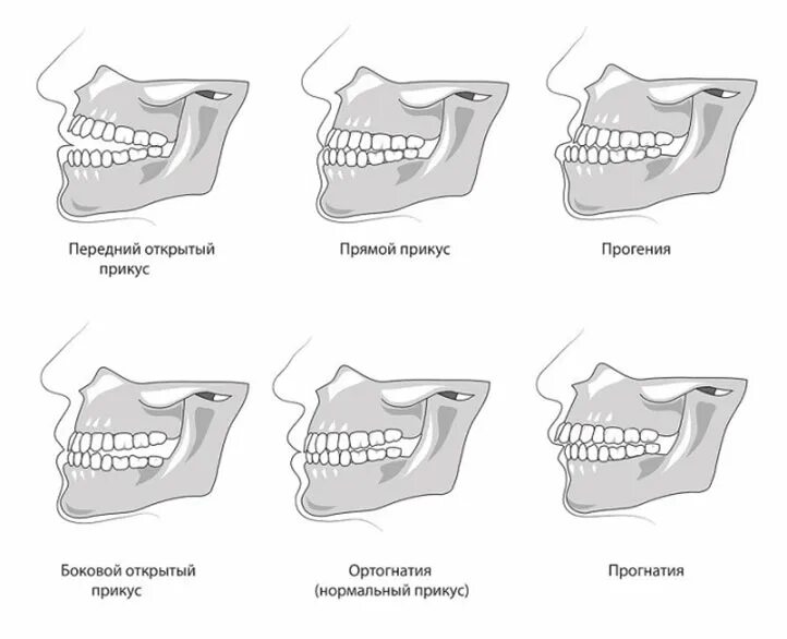 Правильный прикус зубов у человека схема фото Исправление прикуса на Бабушкинской, Медведково в Москве