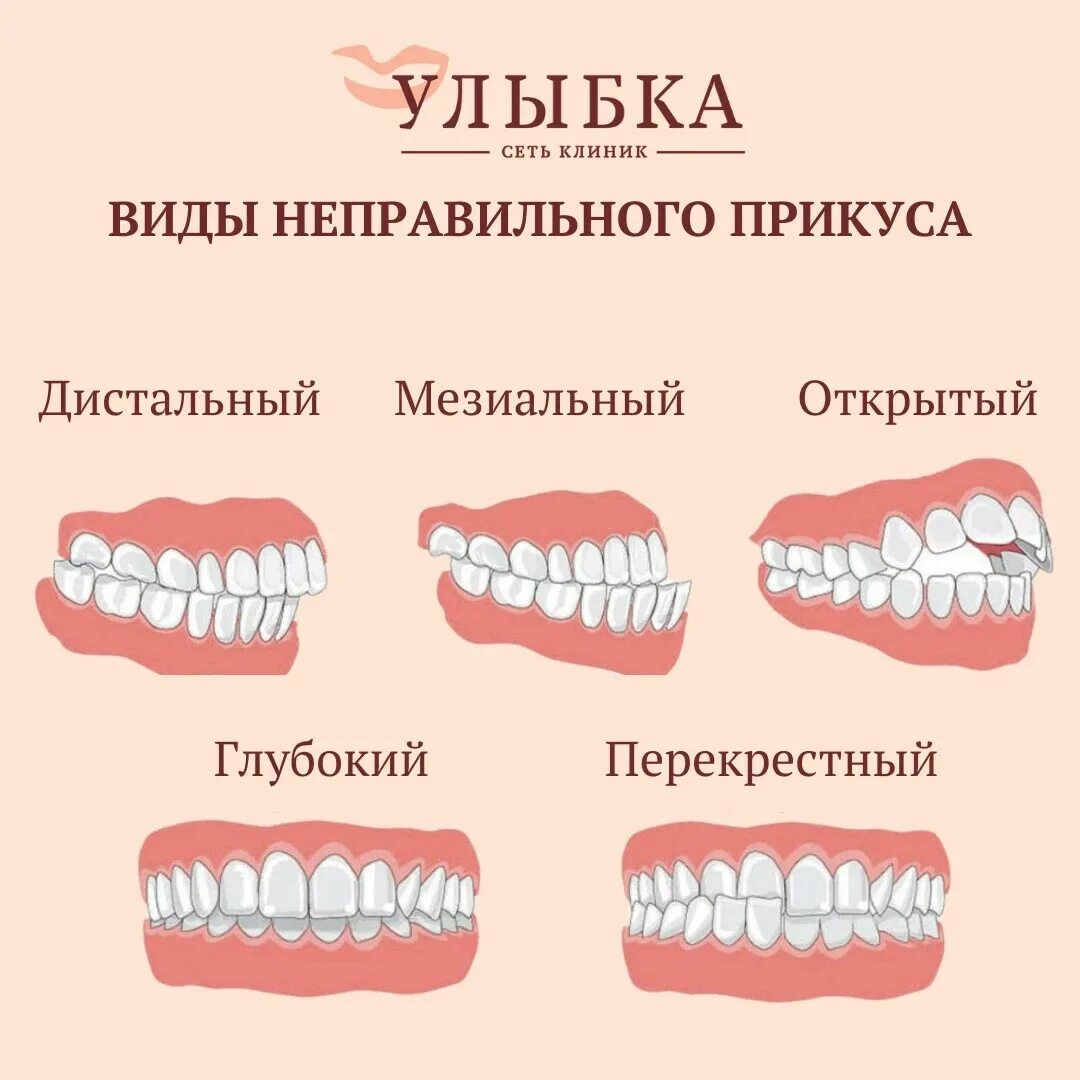 Правильный прикус зубов у человека схема фото Виды неправильного прикуса. Прикус считается неправильным при аномалиях в. Стома