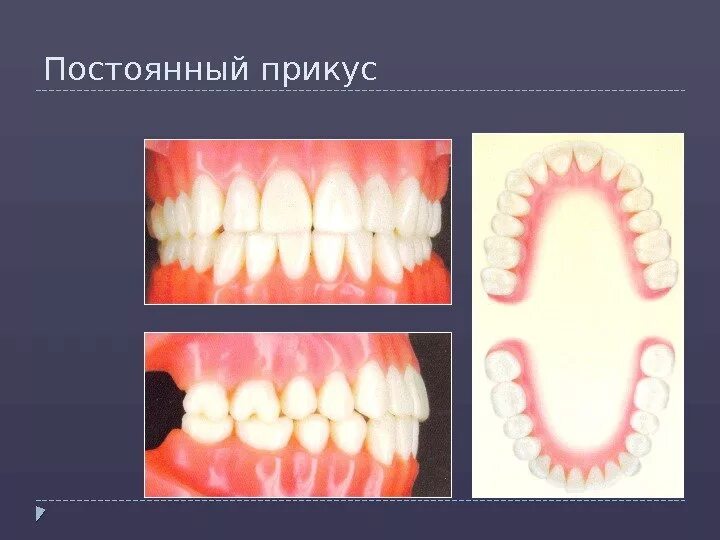 Правильный прикус зубов у человека схема фото Какой должен быть прикус у человека