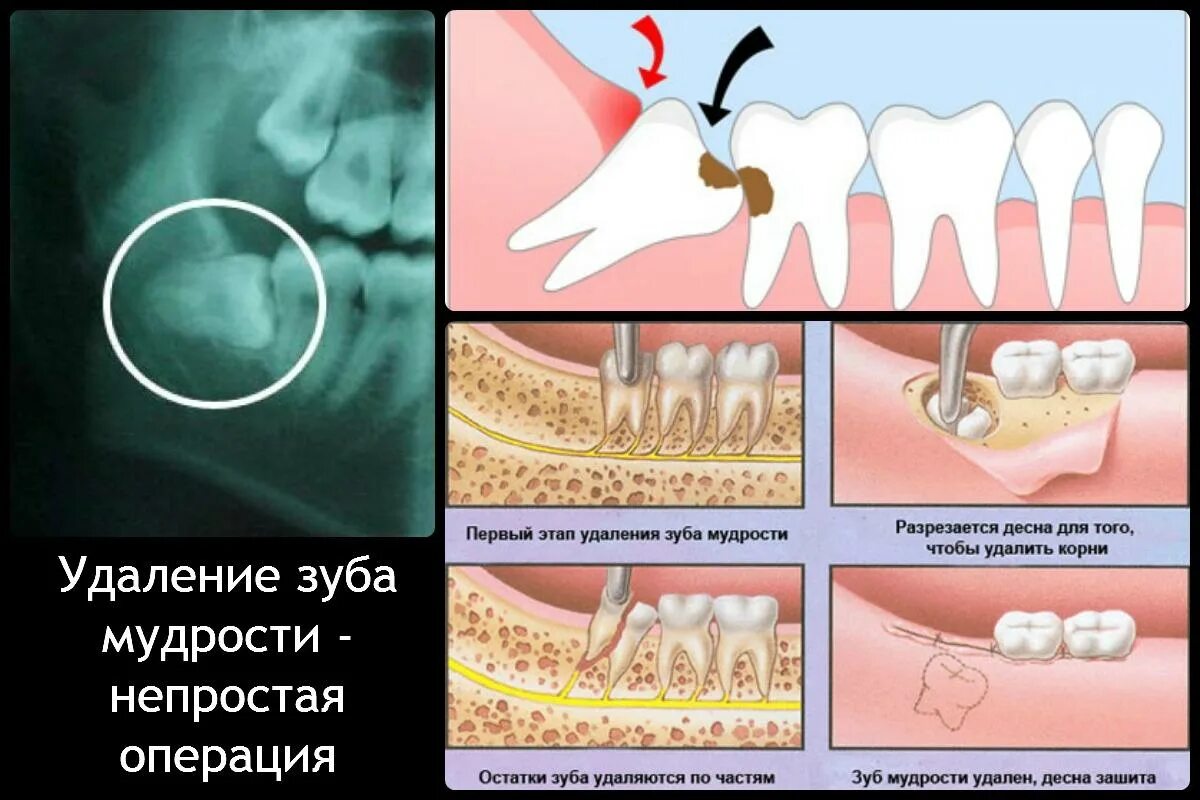 Правильный зуб мудрости фото Удаление зуба мудрости, цены на удаление зубов мудрости в СПб - Анле-Дент