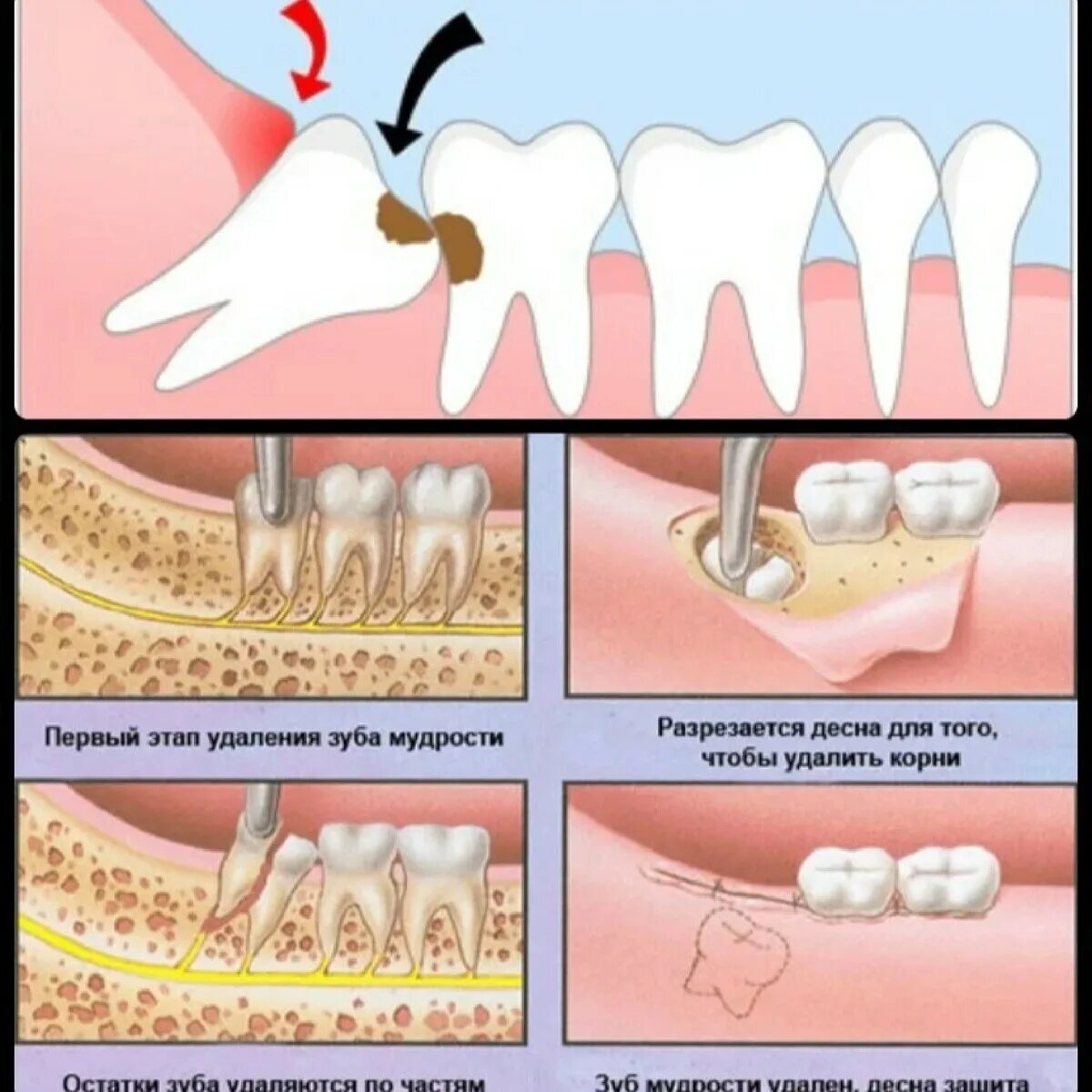 Правильный зуб мудрости фото Почему удаляют зубы мудрости